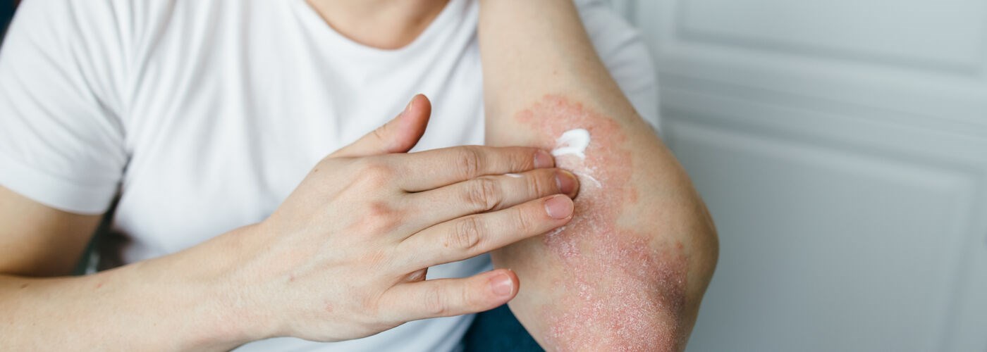 Man using steroid cream for a skin treatment