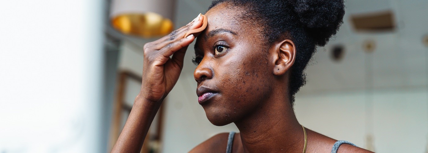Young woman with rosacea on the face applying skin care on her face hero